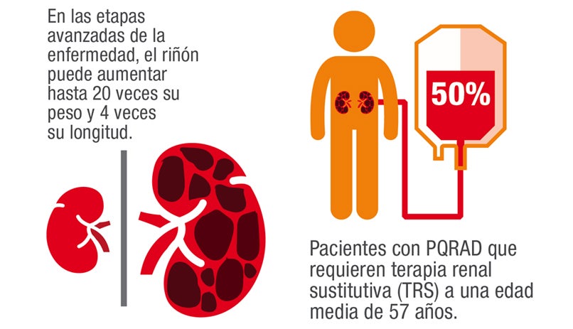 Infografías extraídas del «Libro Blanco de la Poliquistosis Renal Autosómica Dominante en España».